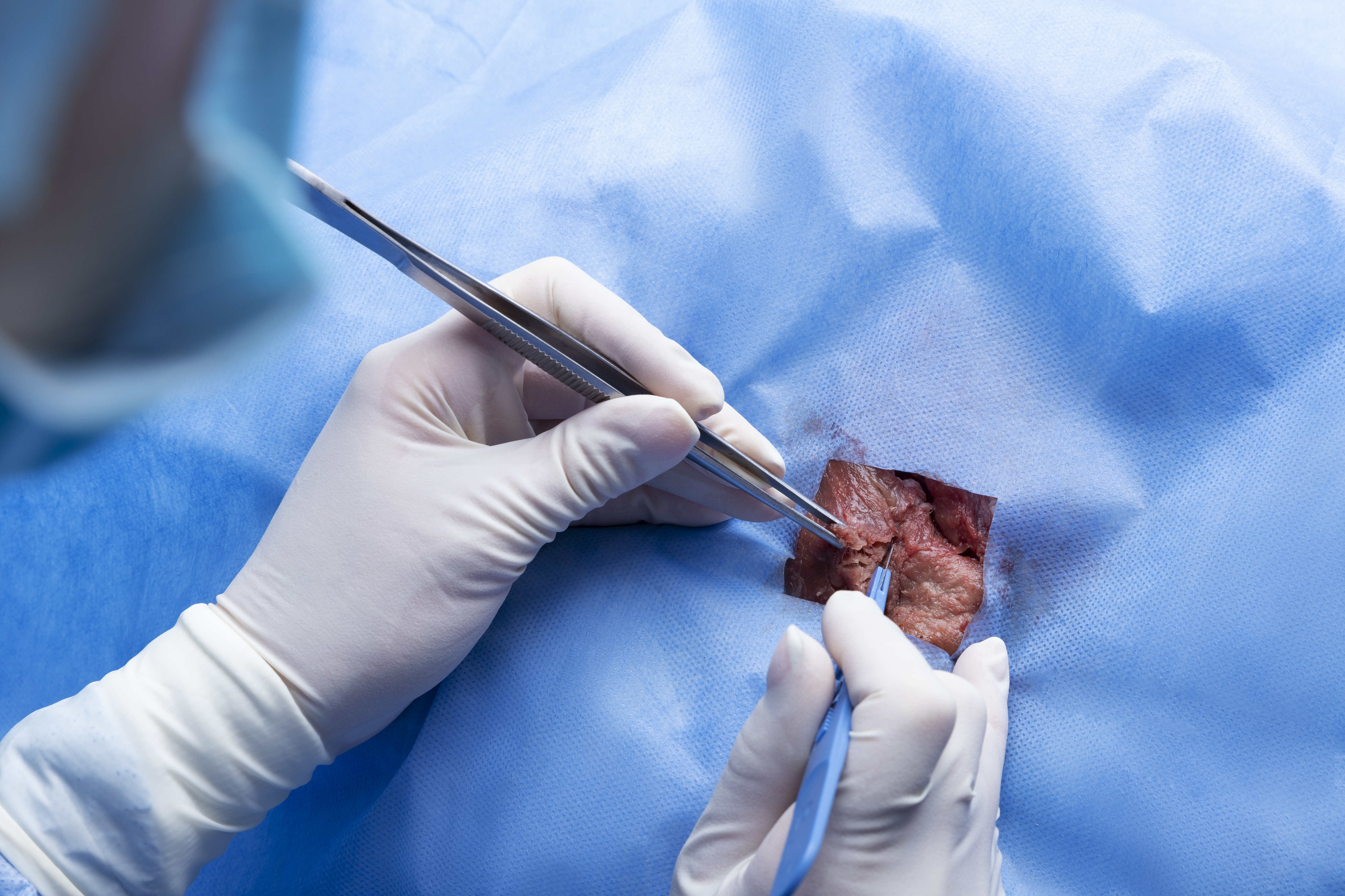 MINIMALLY INVASIVE UROLOGY (KEY-HOLE SURGERIES)
